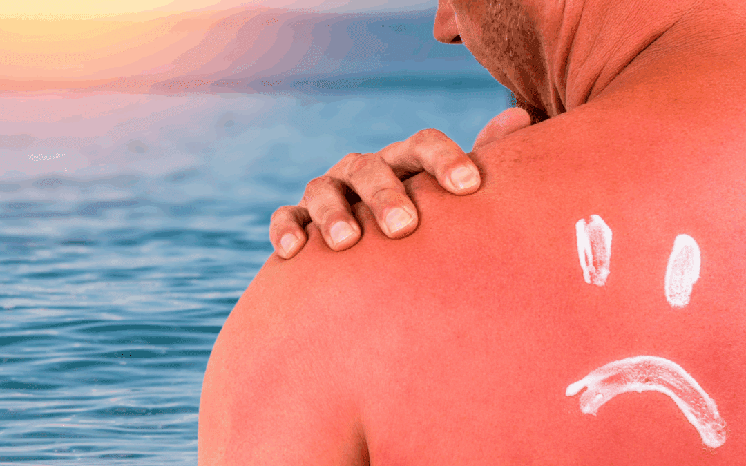 Sunburns and Natural Relief